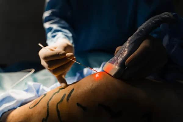 Wie funktioniert die Lasertherapie bei Krampfadern? - Alle Antworten im Krampfadern-Ratgeber