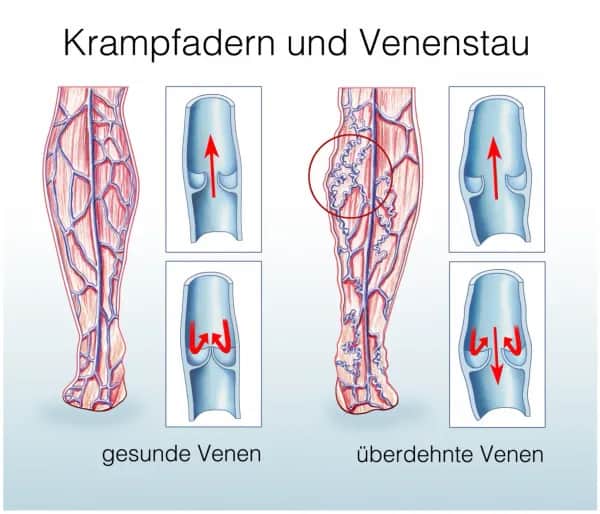 Wann ist eine Operation bei Krampfadern notwendig?