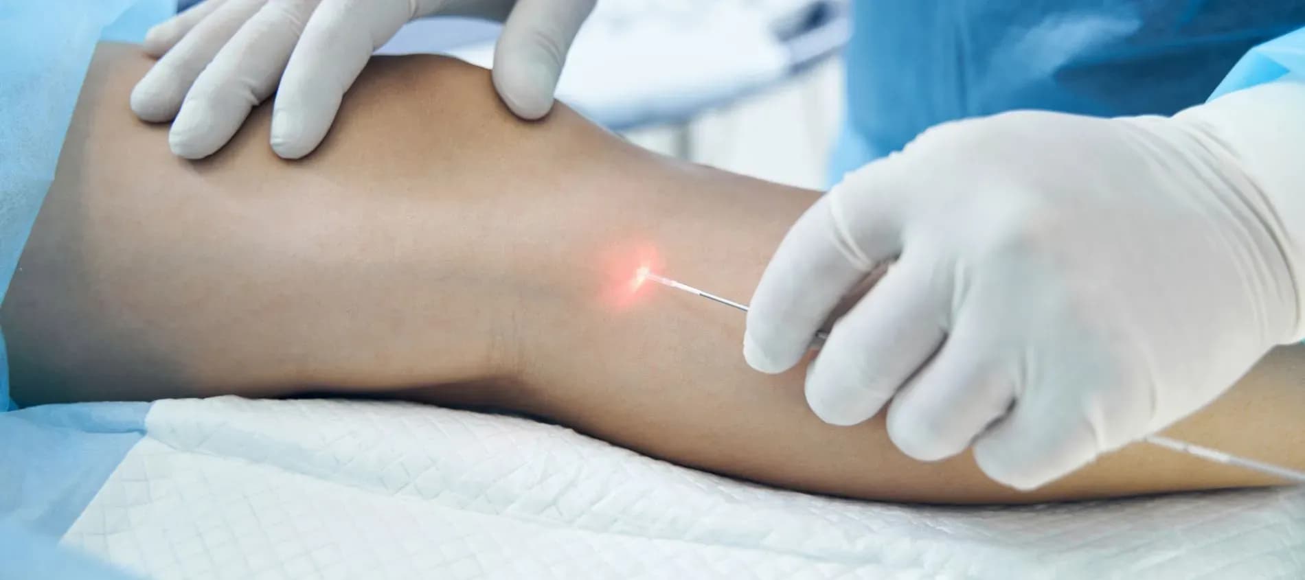 Endovenöse Lasertherapie gegen Krampfadern in Salzburg – Effektiv & schmerzfrei