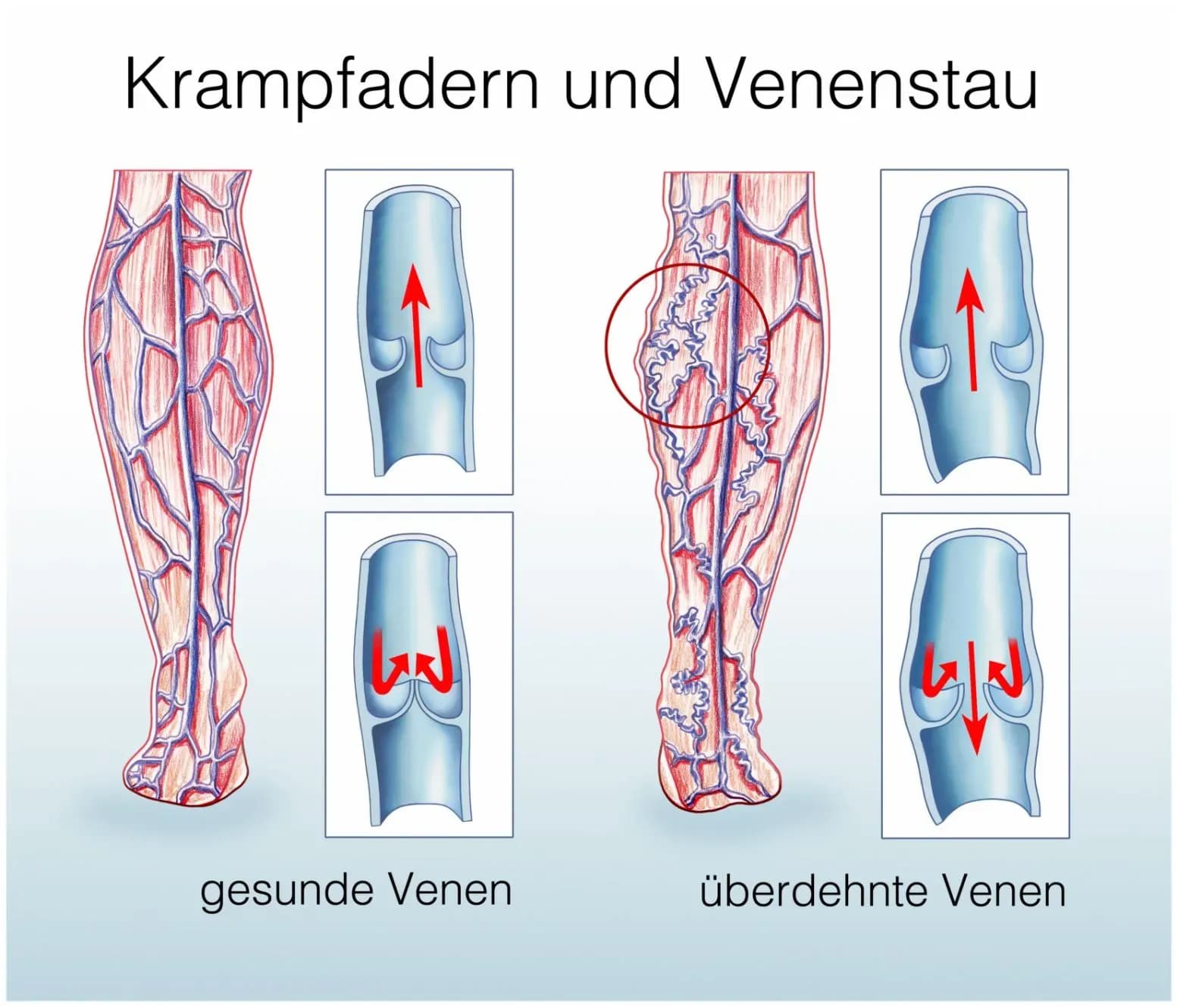 Wann ist eine Operation bei Krampfadern notwendig?