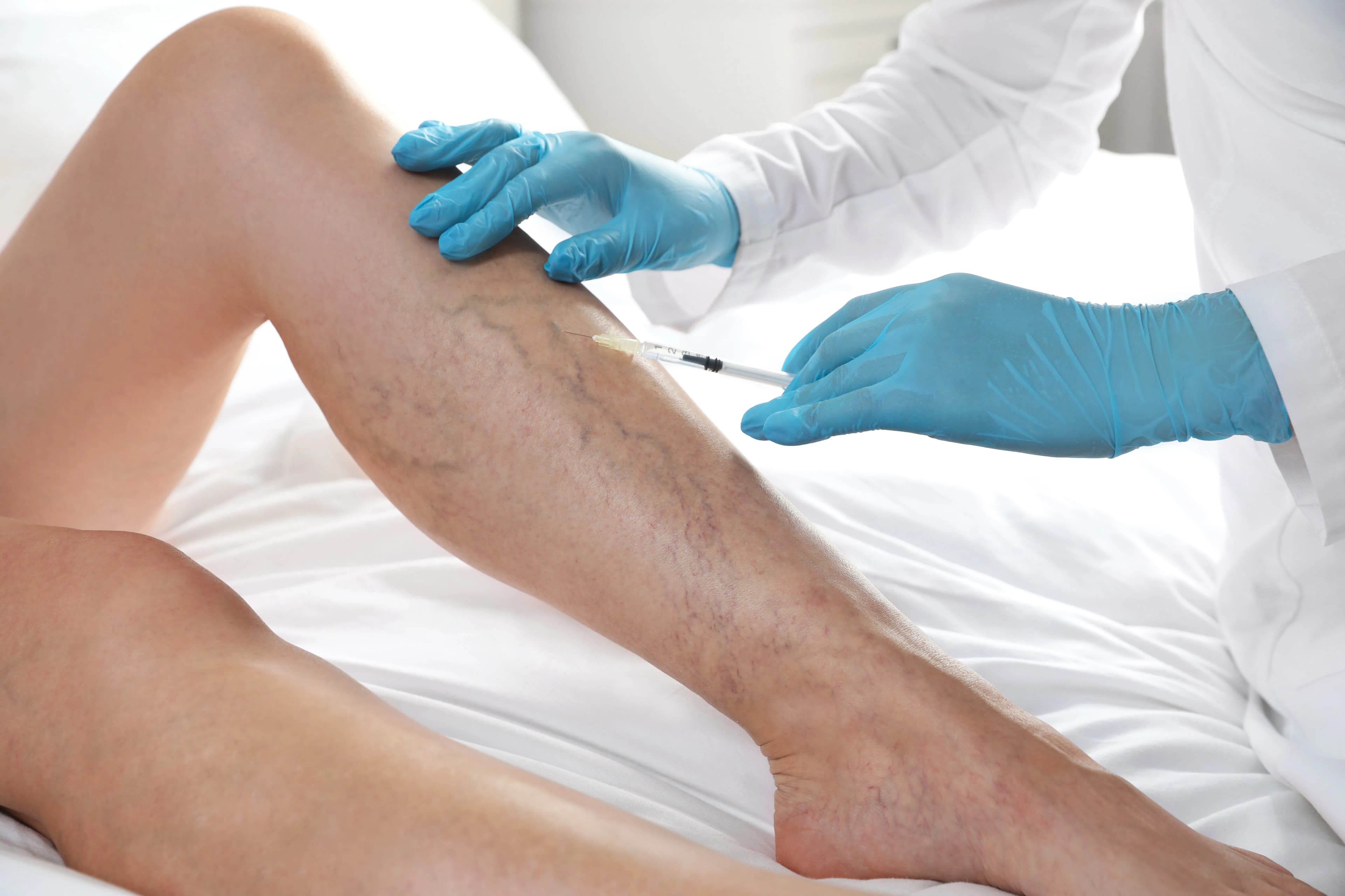 Krampfadern entfernen in Kitzbühel – Modernste Lasertherapie für gesunde Beine