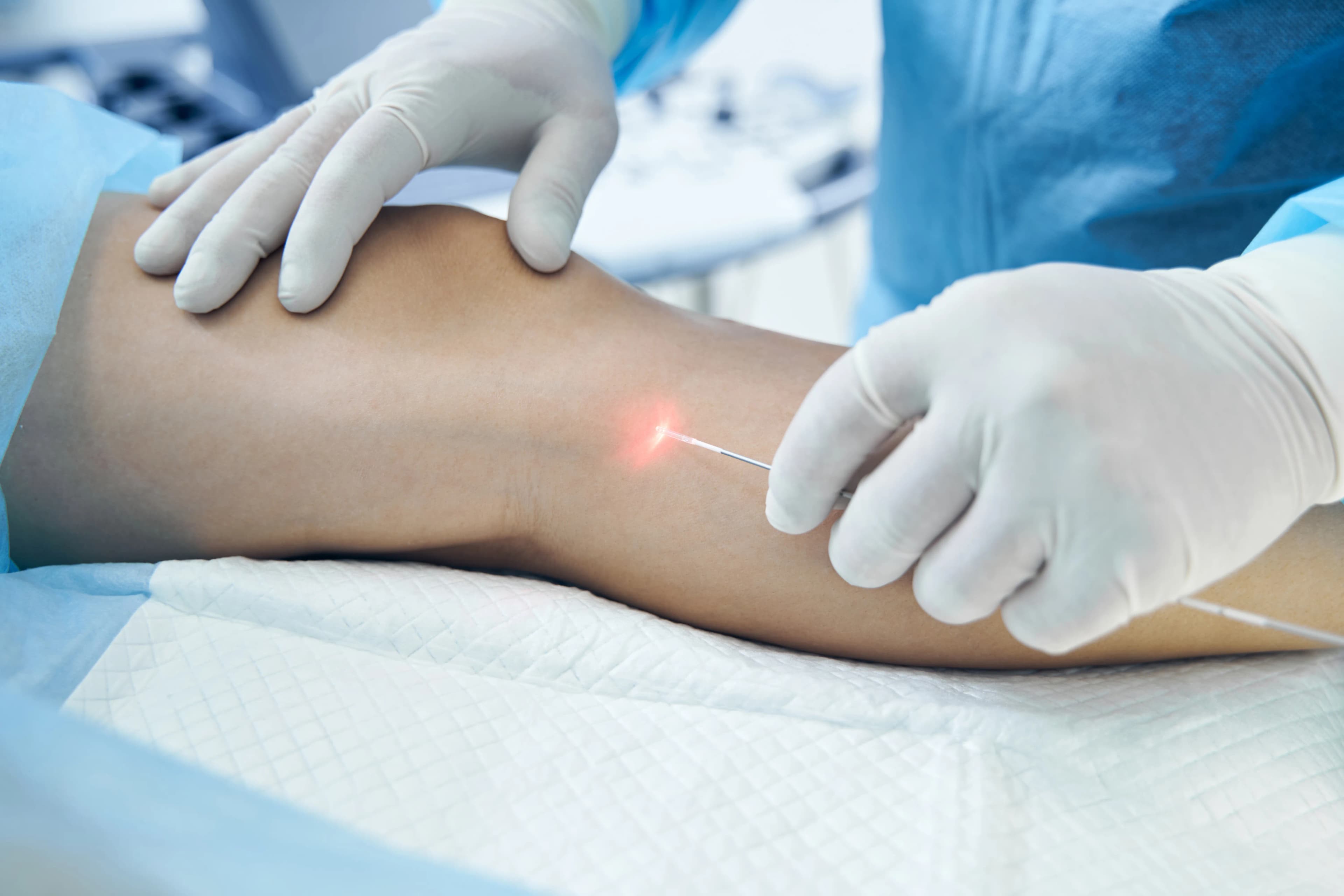 Laserbehandlung von Krampfadern in Rosenheim – Effektive Methode für schöne Beine