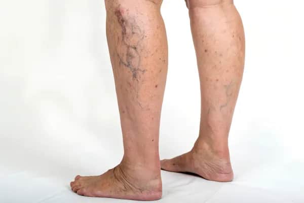 Schonende Lasertherapie gegen Besenreiser und Krampfadern in Salzburg