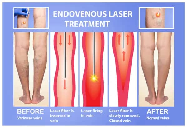 Ist eine Laserbehandlung gut für Krampfadern?